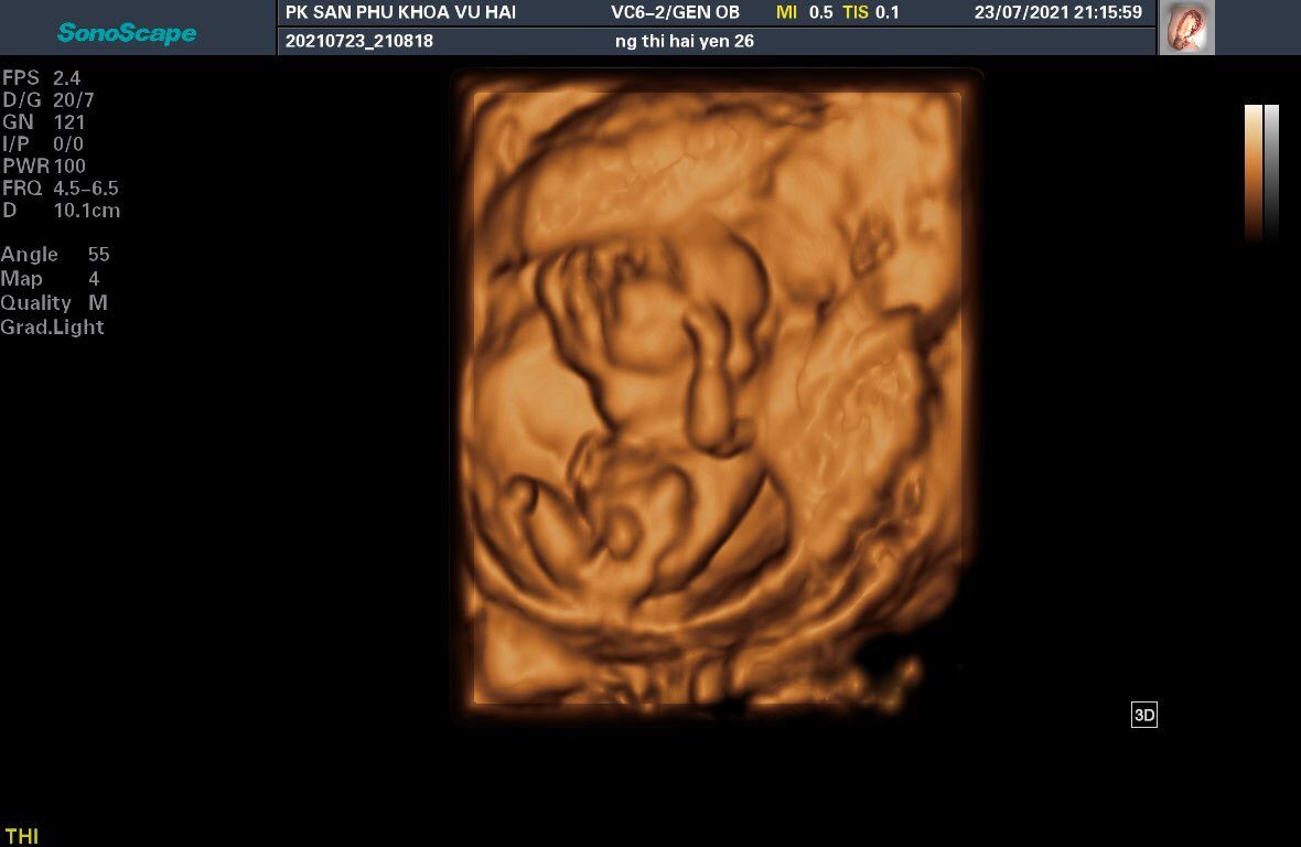 Siêu âm 12 tuần 4 ngày là cơ hội để bạn chiêm ngưỡng sự phát triển nhanh chóng của thai nhi. Bạn sẽ thấy được những chi tiết nhỏ bé ở từng bức ảnh siêu âm, đem lại cho bạn sự kỳ diệu và sự yên bình.