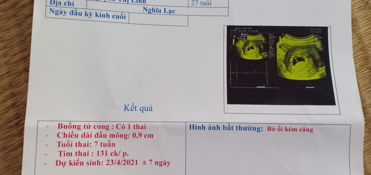 Nguyên Nhân Gây Méo Túi Ối ở Thai 7 Tuần và Cách Nhận Biết