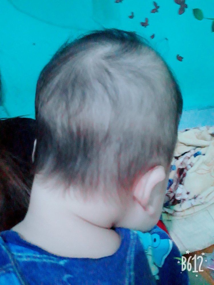 Sự thật tác hại về bẹt đầu do bé nằm nhiều  Sức khỏe  Việt Giải Trí